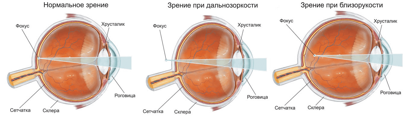 Зрение 0 7 0 8. Зрение минус. Зрение -2.5. Зрение минус 2.5. Минусы зрения человека.